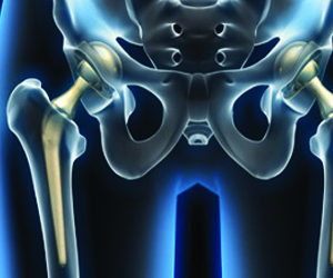 Предстоит замена сустава