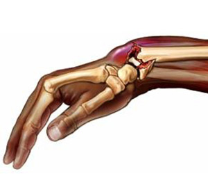 Травма конечностей